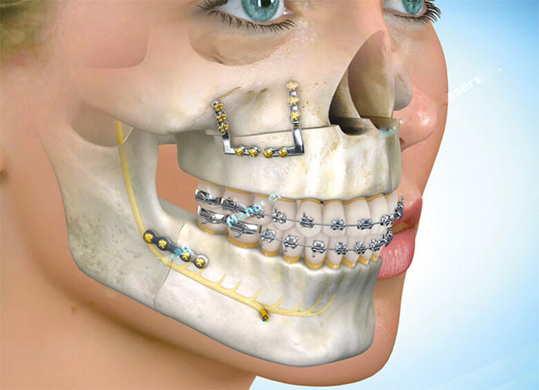 Cirurgia Buco Maxilo Facial