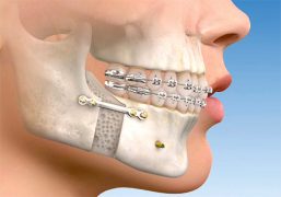 Preciso remover as placas e parafusos depois da cirurgia ortognatica?
