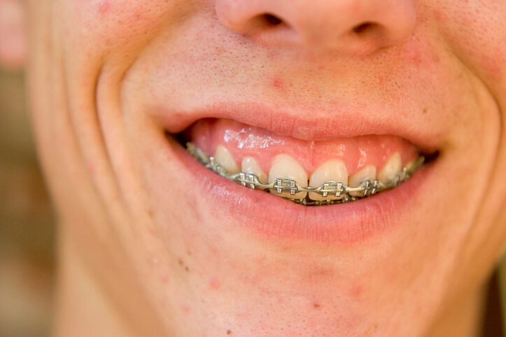 Pessoas que possuem sorriso gengival podem precisar da cirurgia ortognática