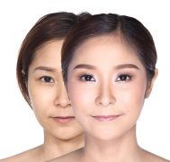 A imagem mostra uma mulher asiatica antes e depois de uma uma cirurgia V-line no rosto para acentuar a linha V da mandibulae maxilar