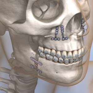 cranio com placas e parafusos